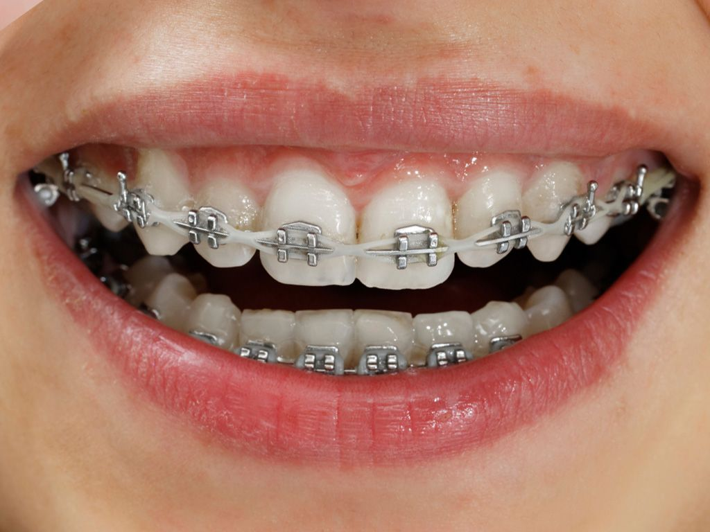 Metal Braces