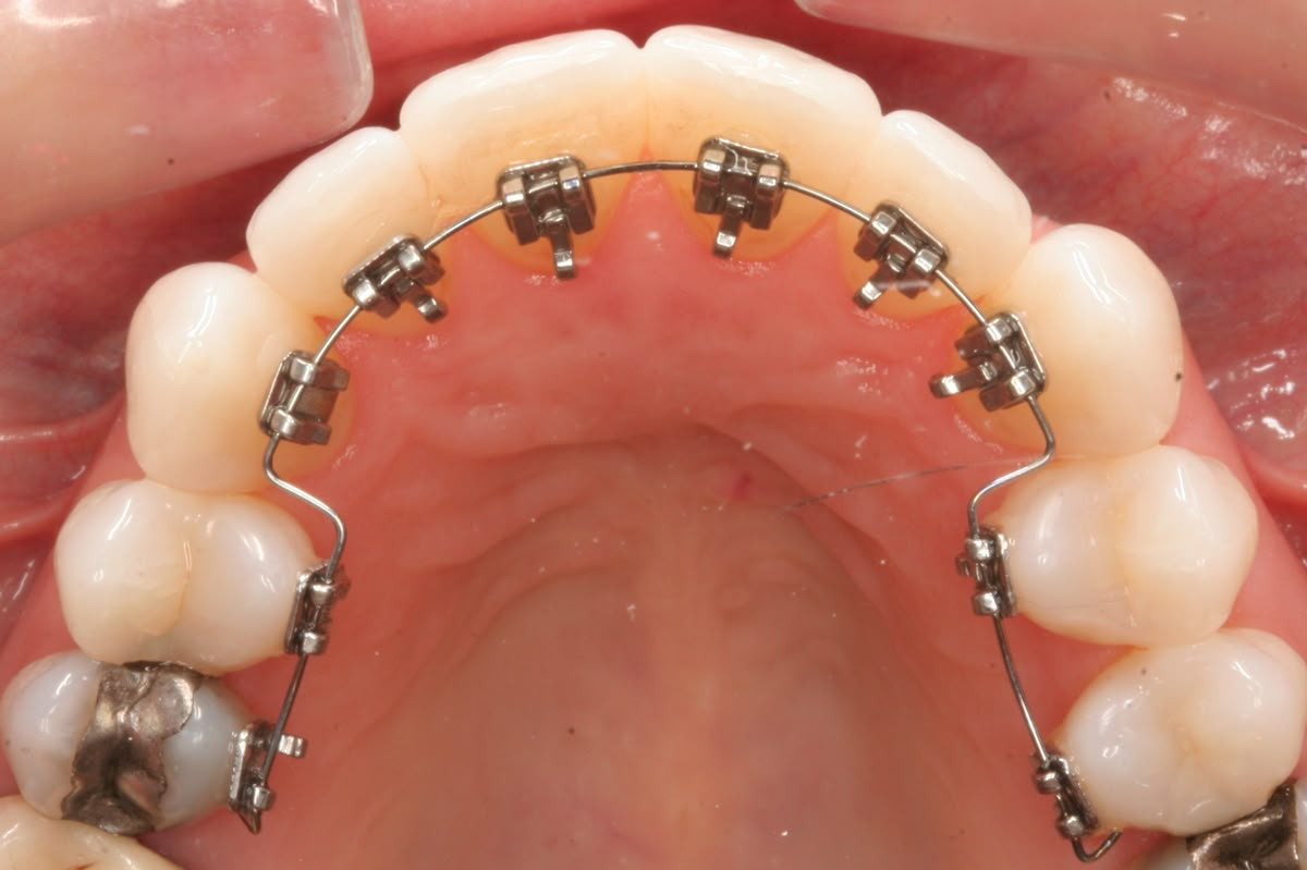 Lingual Braces