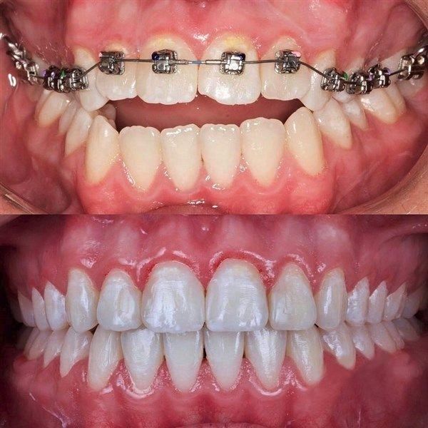 Child smiling with braces or aligners