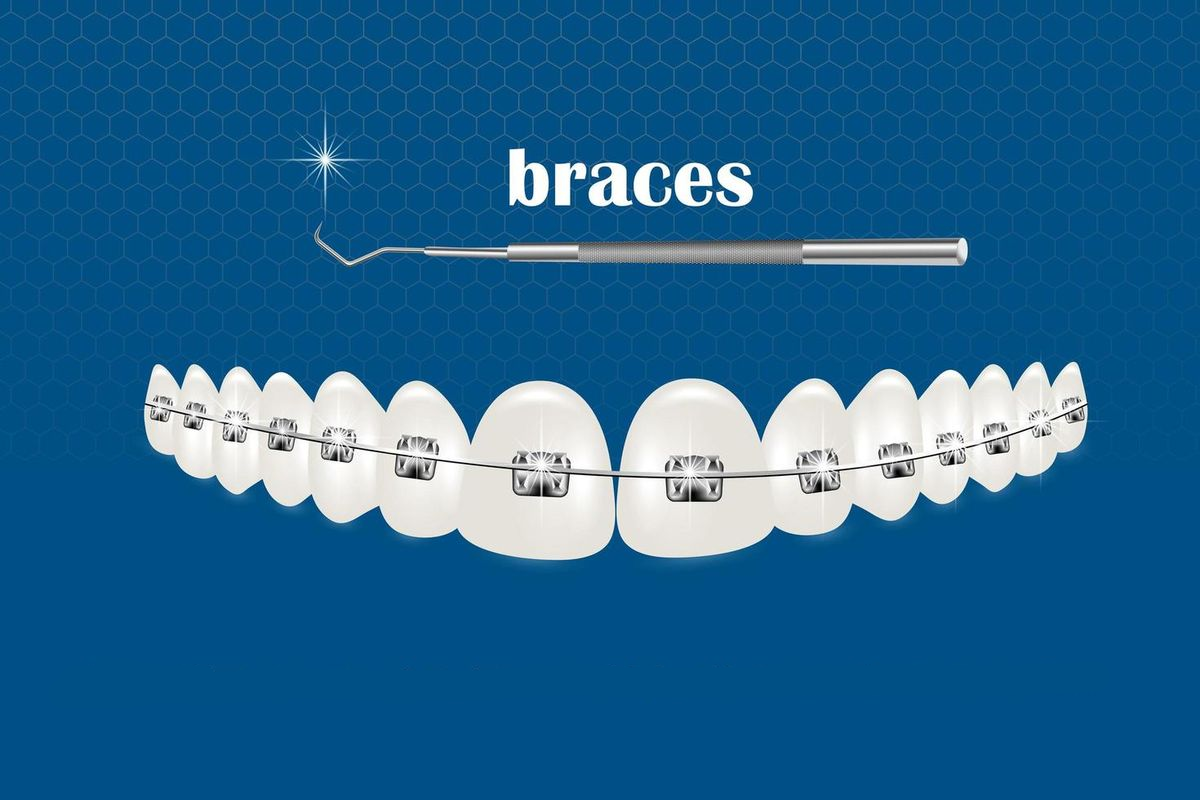 Smiles Braces