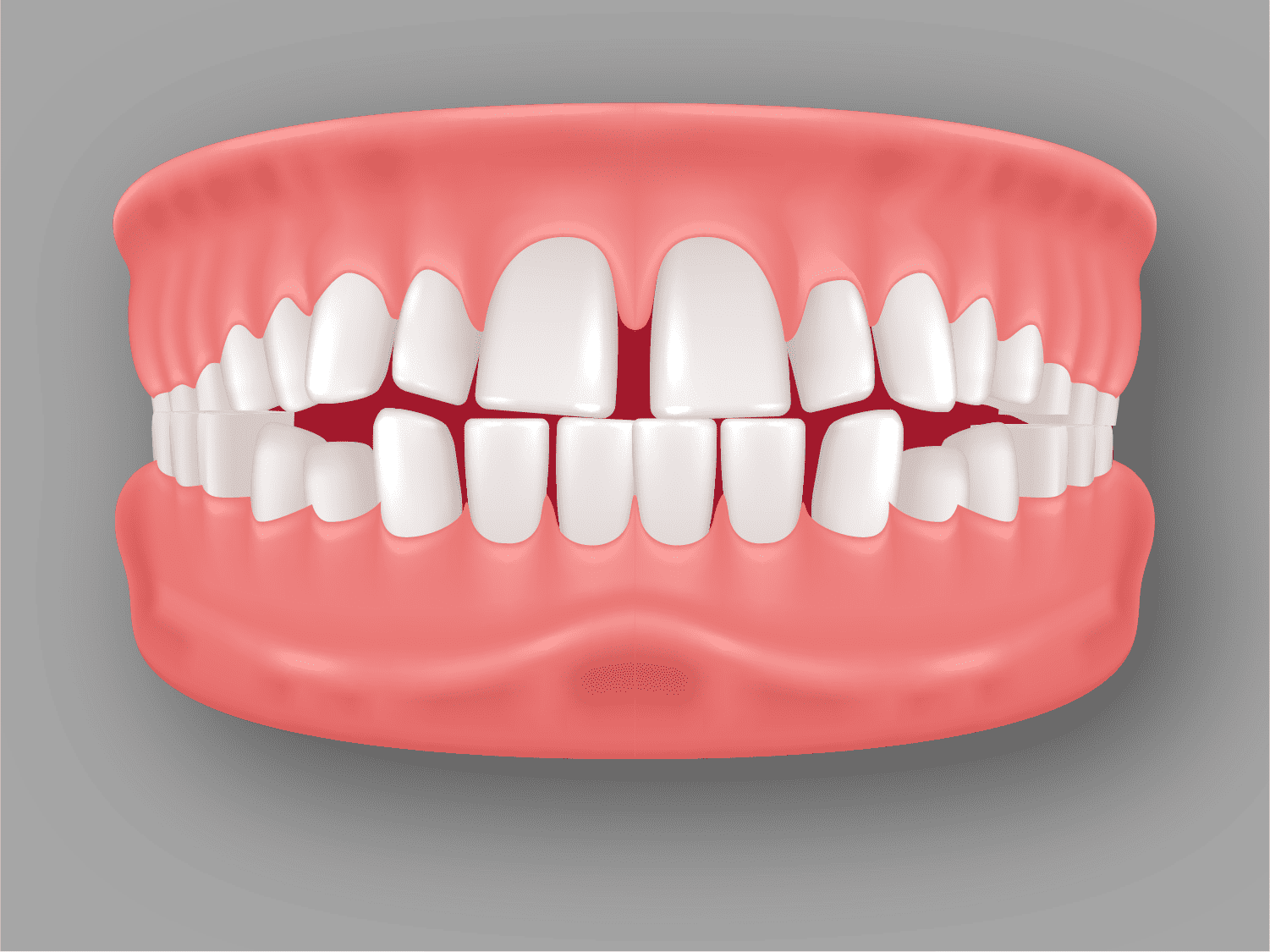 Malocclusion
